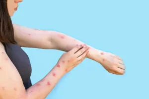 تحذير في تورونتو بعد تعرّض محتمل للحصبة في أماكن عامة